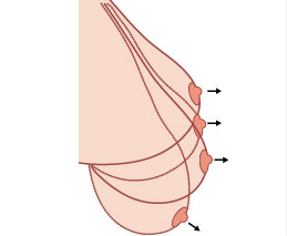 腺体性乳房下垂