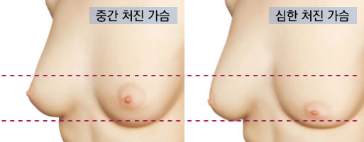 乳房下垂程度