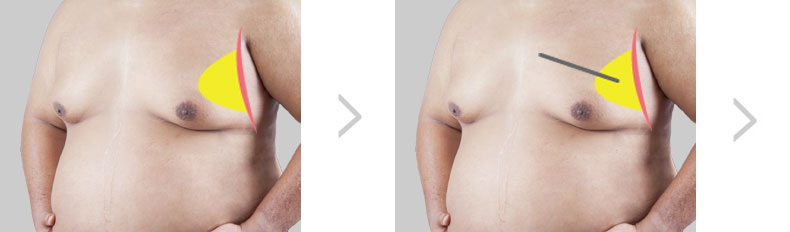 男性乳房发育症手术 第1步