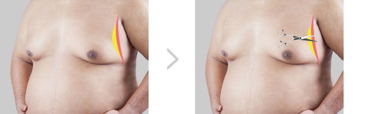 男性乳房发育症手术 第2步