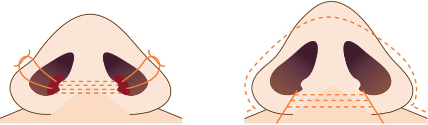 콧볼 안쪽 묶기