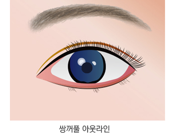 쌍꺼풀 종류