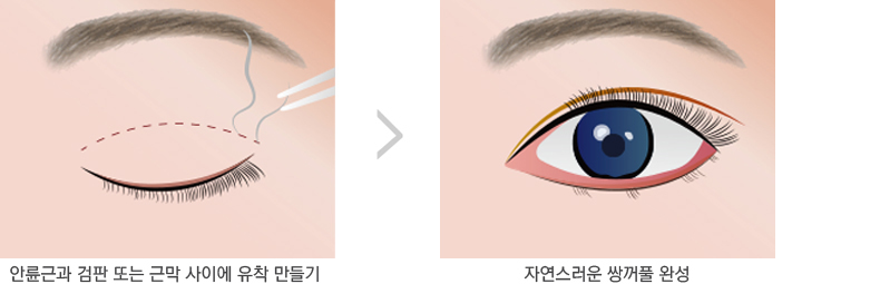 쌍꺼풀