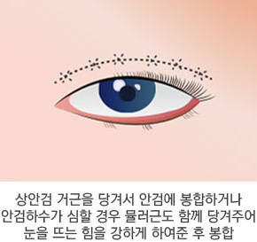 절개 눈매교정술 수술방법 2단계