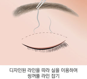 눈매교정술 4단계