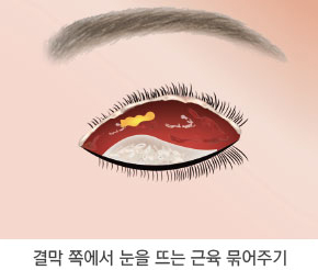 눈매교정술 5단계