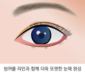 눈매교정술 6단계