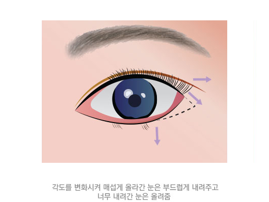눈트임성형