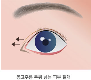 일반적인 앞트임 수술법 2단계