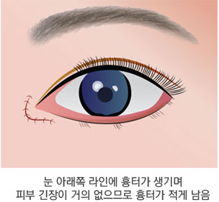 Skin Redraping(피부 재배치) 방법 3단계