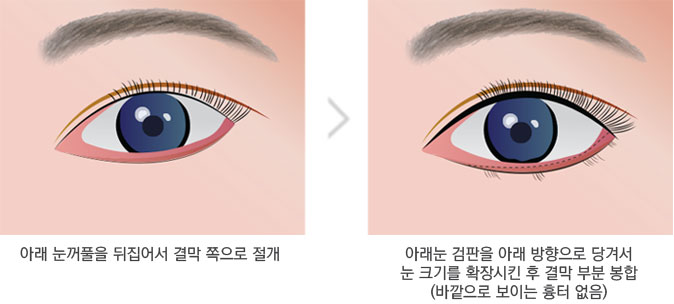 밑트임 수술방법