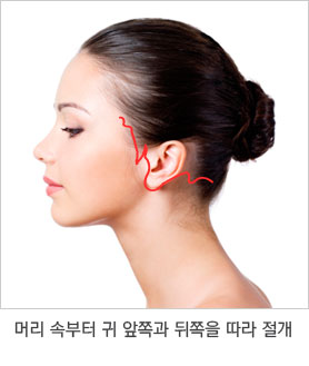 수술 과정 1단계