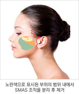 수술 과정 2단계