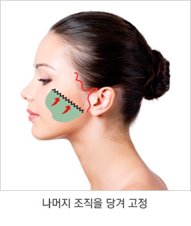 수술 과정 3단계