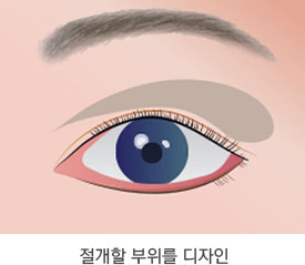 상안검 성형술 수술방법 1단계
