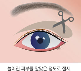 상안검 성형술 수술방법 2단계