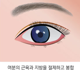 상안검 성형술 수술방법 3단계
