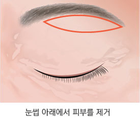 눈썹 아래 올림술 수술 과정 2단계
