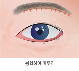 눈썹 아래 올림술 수술 과정 3단계