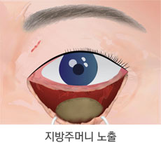 눈밑 지방이 불룩하고 피부가 처진 경우 3단계