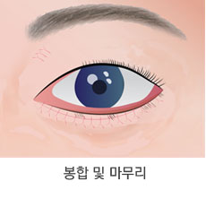 눈밑 지방이 불룩하고 피부가 처진 경우 6단계