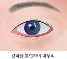 피부 처짐이 거의 없이 지방만 볼록한 경우 3단계