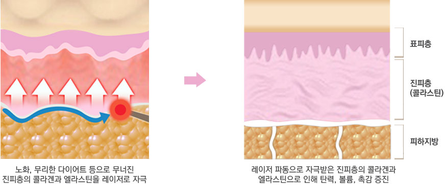 시술 원리