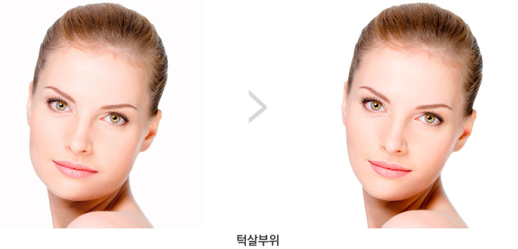 시술 부위