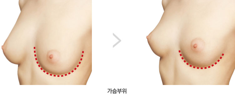 시술 부위