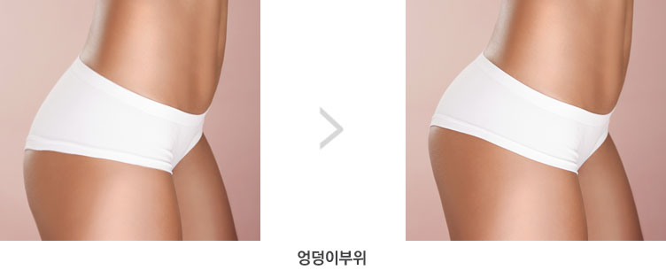 시술 부위