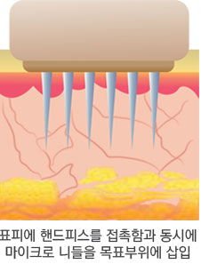 시술 원리 1단계