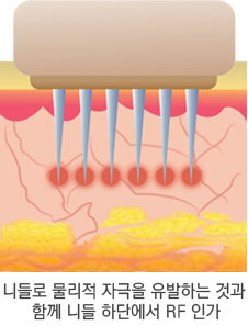 시술 원리 2단계