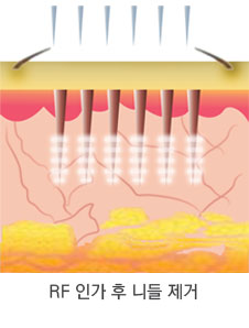 시술 원리 3단계
